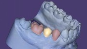 Exocad DentalCAD Implant Lab Bundle
