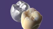 Exocad DentalCAD Implant Lab Bundle