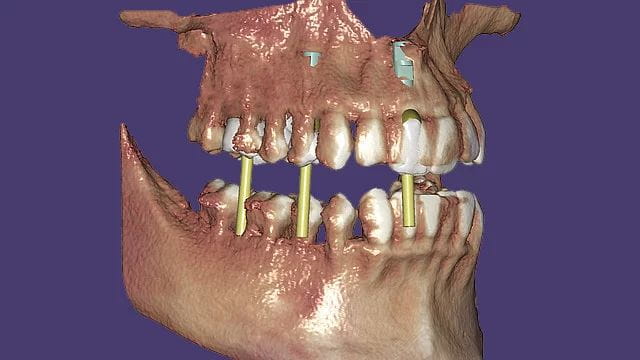 Exocad DentalCAD Implant Lab Bundle
