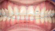 Exocad DentalCAD Ultimate Lab Bundle