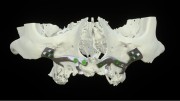 Bone Easy - Implant hybrydowy - Rehabilitacja atrofii szczęk
