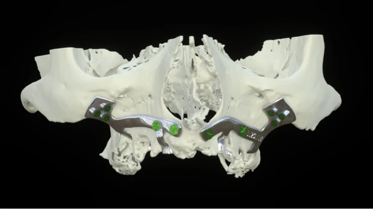 Bone Easy - Implant hybrydowy - Rehabilitacja atrofii szczęk