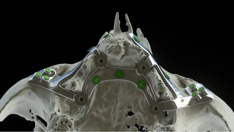 Bone Easy - Implant hybrydowy - Rehabilitacja atrofii szczęk