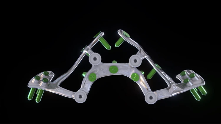 Bone Easy - Implant hybrydowy - Rehabilitacja atrofii szczęk