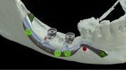 Bone Easy - Implant hybrydowy - Rehabilitacja atrofii szczęk