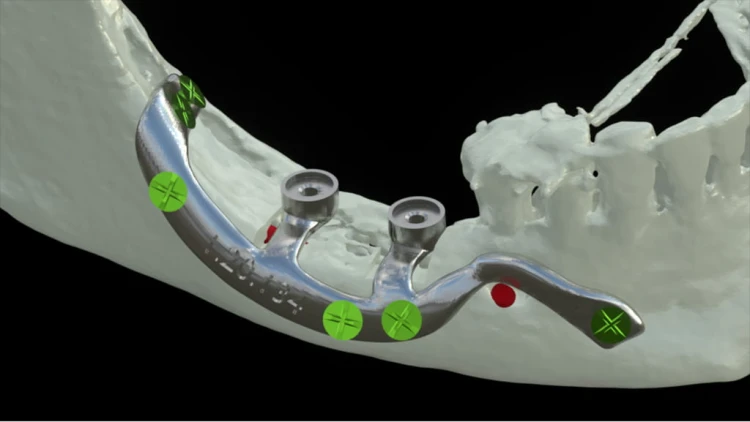 Bone Easy - Implant hybrydowy - Rehabilitacja atrofii szczęk
