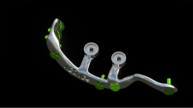 Bone Easy - Implant hybrydowy - Rehabilitacja atrofii szczęk