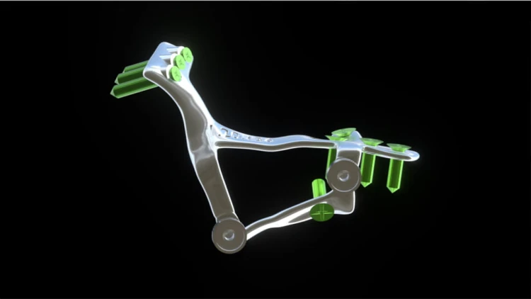 Bone Easy - Implant hybrydowy - Rehabilitacja atrofii szczęk
