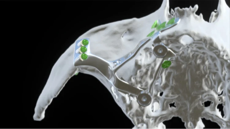 Bone Easy - Implant hybrydowy - Rehabilitacja atrofii szczęk