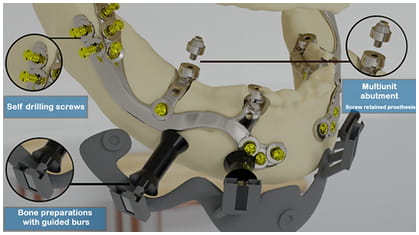 Bone Easy - Implant kompaktowy - Koncepcja integracji mięśniowo-szkieletowej