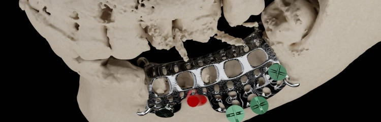 Bone Easy - Mesh4U -  Sterowana regeneracja kości