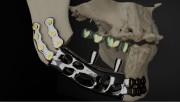 Bone Easy - ICMF - Proteza czaszkowo-szczękowo-twarzowa