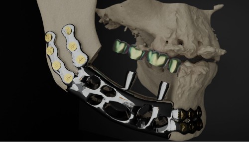 Bone Easy - ICMF - Proteza czaszkowo-szczękowo-twarzowa