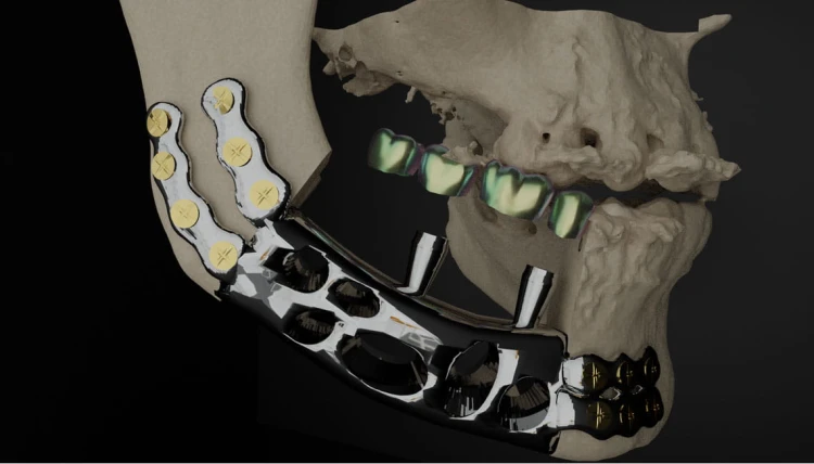 Bone Easy - ICMF - Proteza czaszkowo-szczękowo-twarzowa