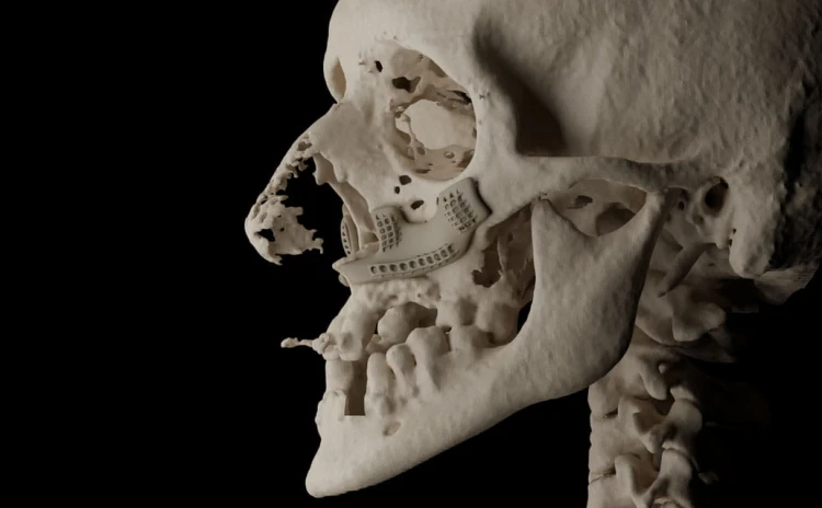 Bone Easy - ICMF - Proteza czaszkowo-szczękowo-twarzowa